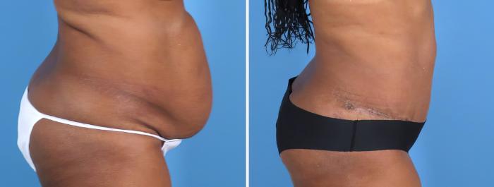 Tummy Tuck Before & After Case 27022