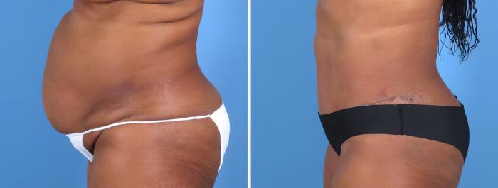 Tummy Tuck Before & After Case 27022