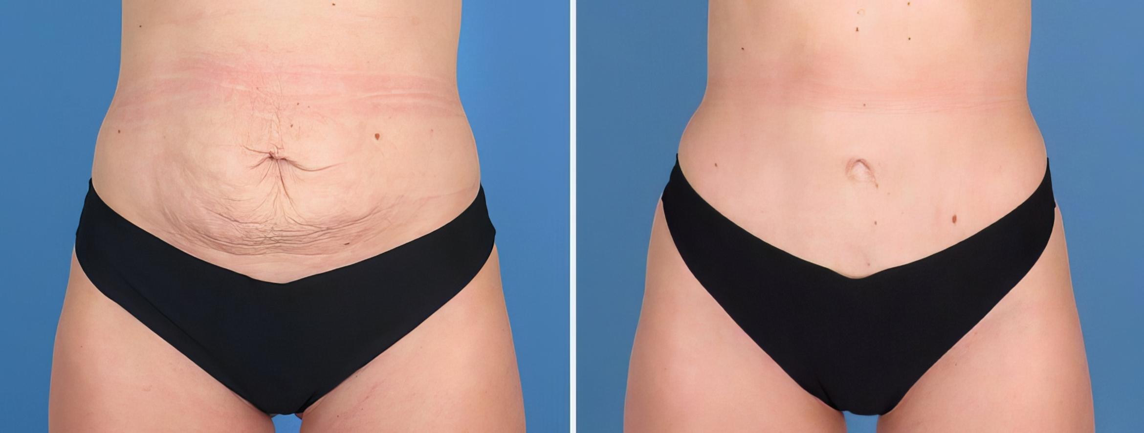 Tummy Tuck Before & After Case 27155