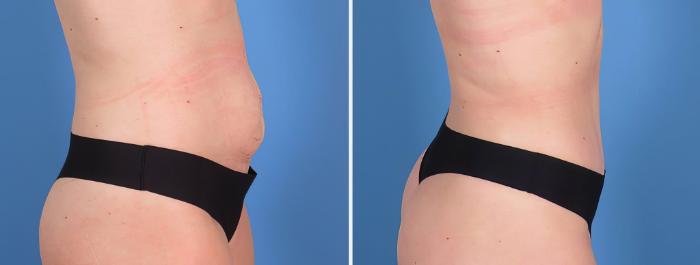 Tummy Tuck Before & After Case 27155