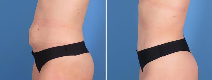Tummy Tuck Before & After Case 27155