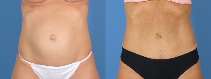 Tummy Tuck Before & After Case 28308