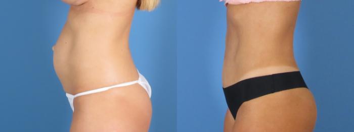 Tummy Tuck Before & After Case 28308