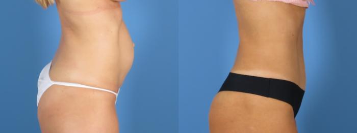 Tummy Tuck Before & After Case 28308