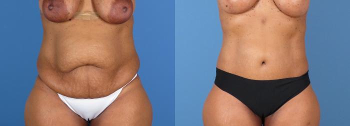 Tummy Tuck Before & After Case 28310