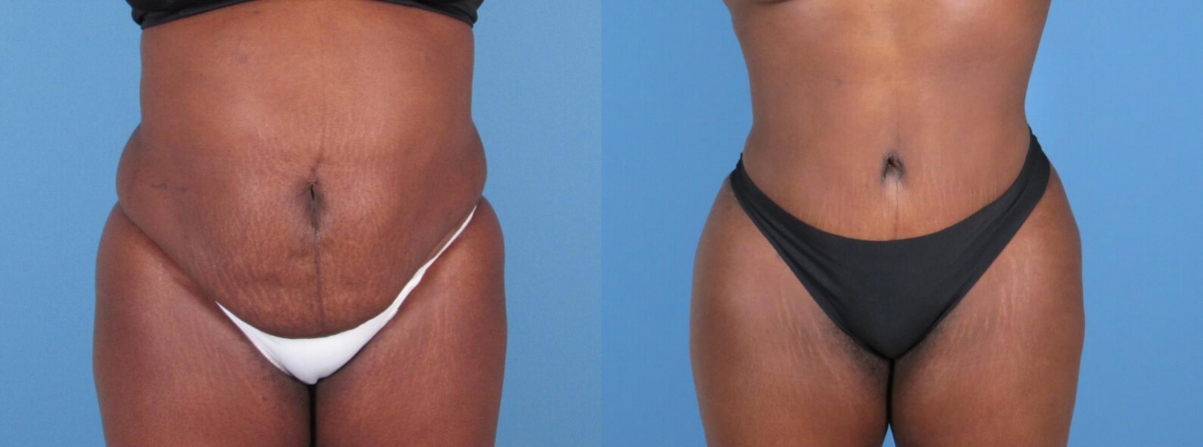 Tummy Tuck Before & After Case 28311
