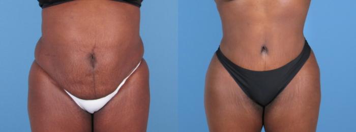 Tummy Tuck Before & After Case 28311