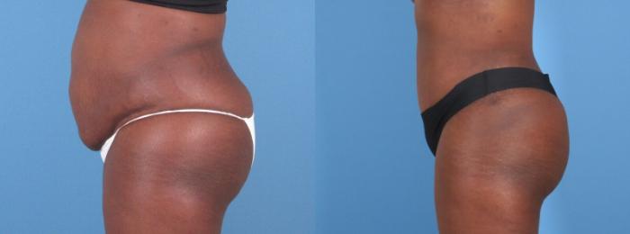 Tummy Tuck Before & After Case 28311