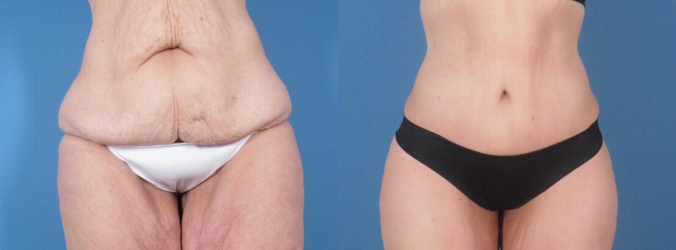 Tummy Tuck Before & After Case 28312