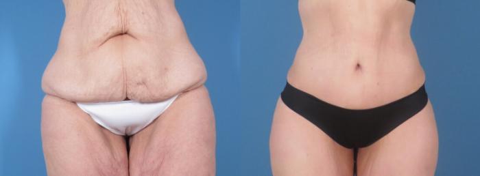 Tummy Tuck Before & After Case 28312