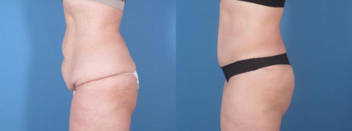 Tummy Tuck Before & After Case 28312