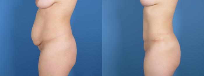 Tummy Tuck Before & After Case 28315