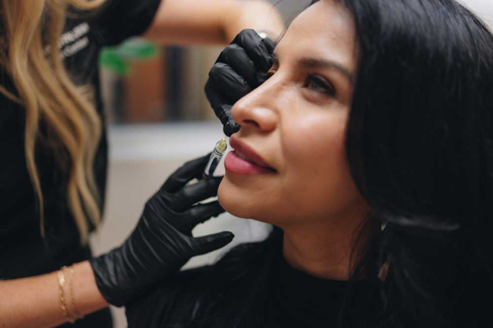 dermal filler treatment